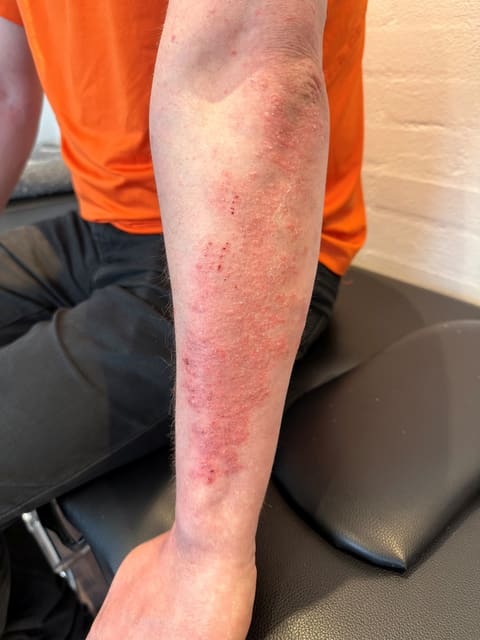 DermaSEMITA+ lysterapi – eksempel på arbejde 2