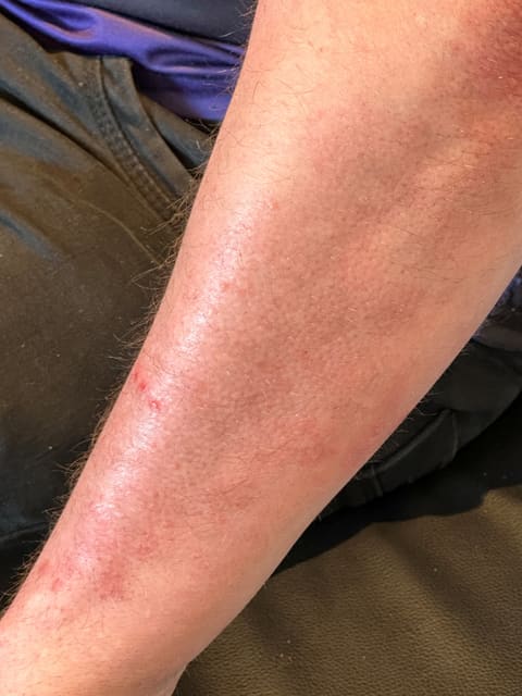 DermaSEMITA+ lysterapi – eksempel på arbejde 3