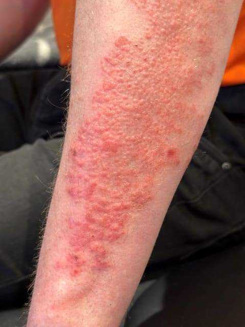 DermaSEMITA+ lysterapi – eksempel på arbejde 1